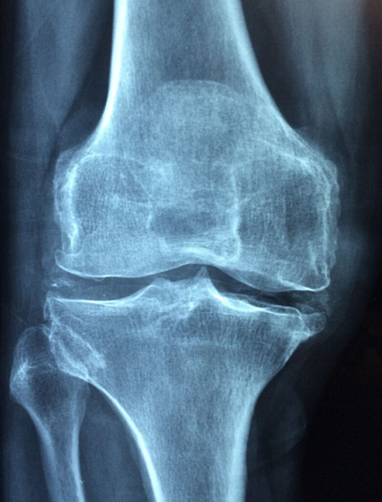 Radiografia de Rodilla
