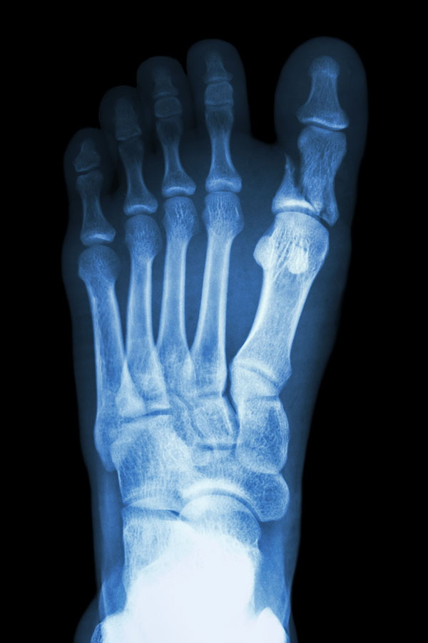 Radiografia de Pie