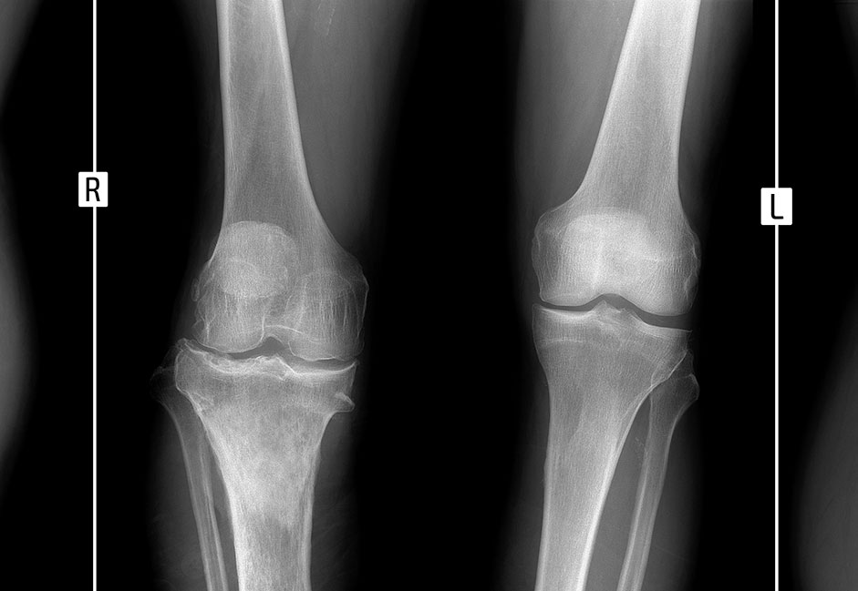Radiografia de Rodilla